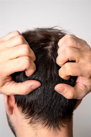 SCALP TREATMENT FOR MEN