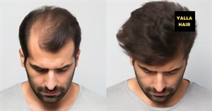 Premium Non-Surgical Hair Replacement for Men in Dubai, Abu Dhabi & Sharjah