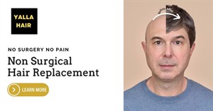 Men’s Hair Patch Fixing in Dubai, Sharjah & Abu Dhabi
